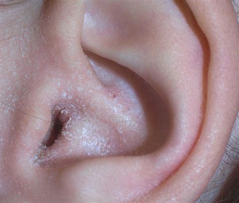 sore on inside of ear