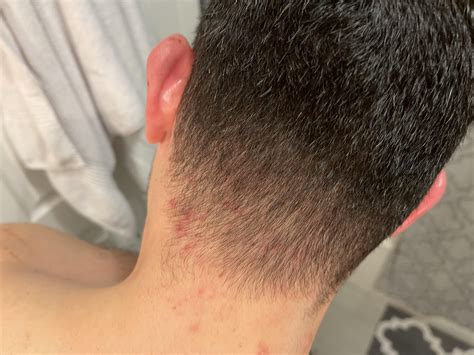 sores on back of neck at hairline