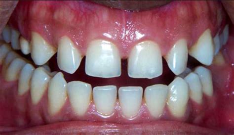 Space Between My Teeth