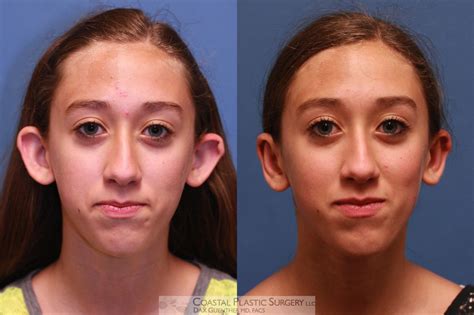 Spacers In Your Ears