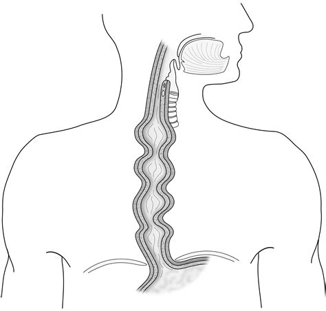spasms of the esophagus