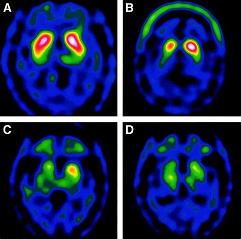 spect scan for parkinson's disease