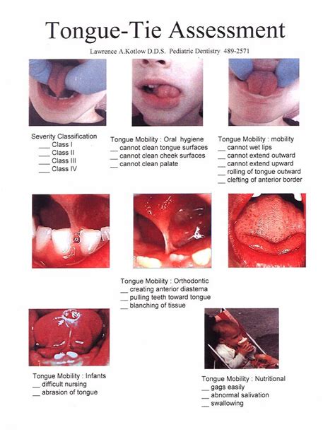 speech therapy tongue tie