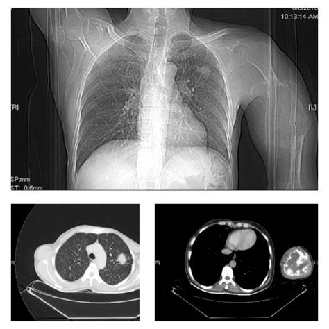 Spiculated Nodule Left Upper Lobe
