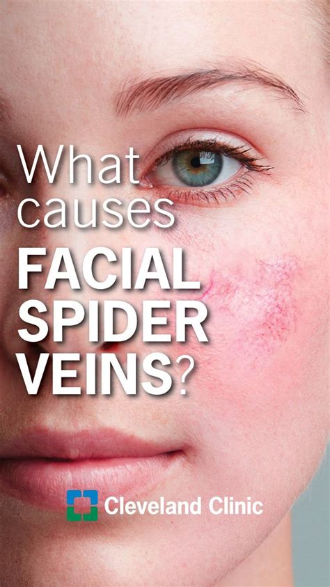 Bremenn Research Labs Facial Spider Vein Formula 30ml Cosmetics Now