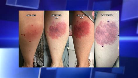 Spider Bites and Bruising: What You Need to Know About Symptoms and Treatment