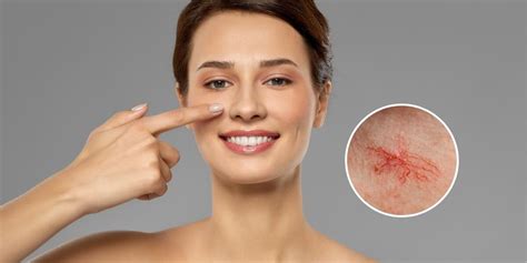 spider vein face