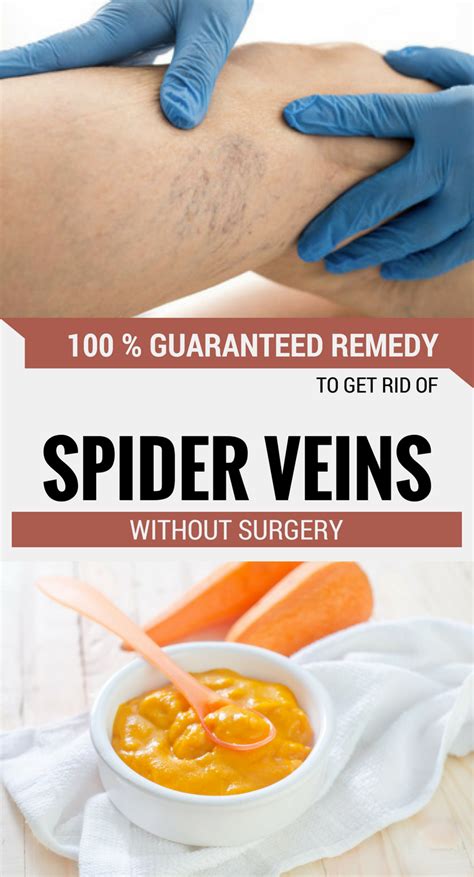 Home Remedies For Spider Veins Natural, Herbal Removal Of Spider