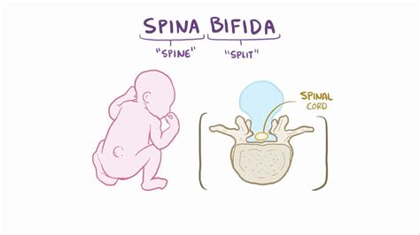 spina bifida is associated with medical term
