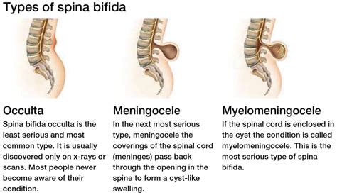 spina bifida medical term