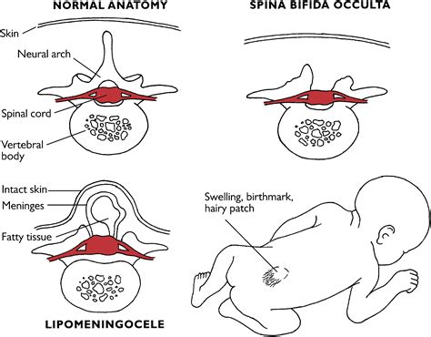 spina bifida symptoms