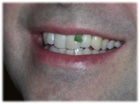 Spinach Residue On Teeth