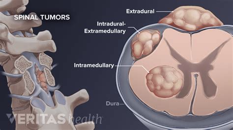 Spinal Cancer Types