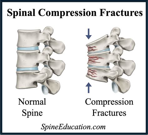 Spinal Compression Fracture Prognosis