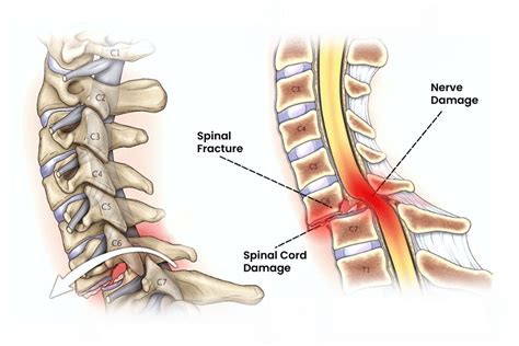 spinal cord bone fracture