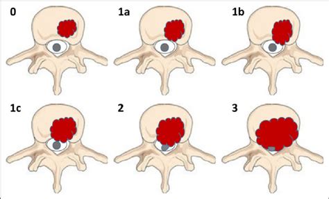 Spinal Cord Compression Grading