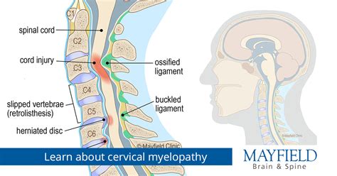 Spinal Cord Compression Vs Myelopathy