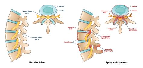 Spinal Cord Compression Vs Stenosis