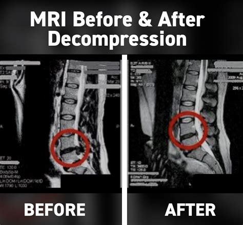 spinal decompression surgery success rate