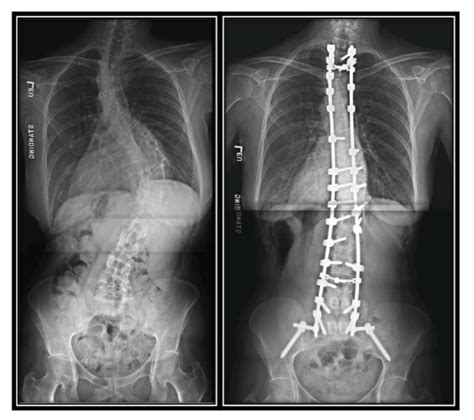 spinal fusion surgery success rate