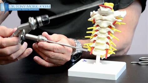 spinal neck surgery success rate