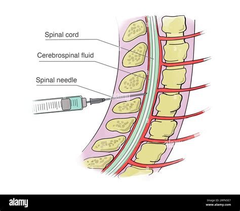 Understanding the Spinal Tap Test: Diagnosis and Procedure Insights