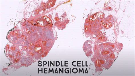 Spindle Cell Dermatology