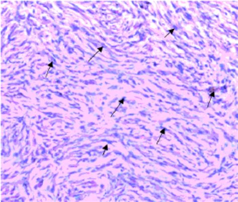 Spindle Cell Histology