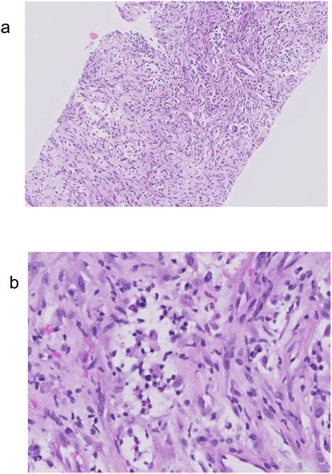 Spindle Cell Proliferation