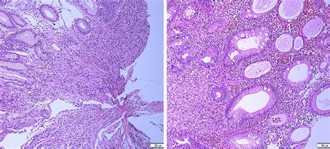 Spindle Cell Proliferation Colon