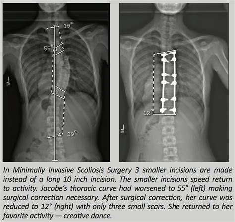spine correction surgery success rate