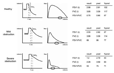 Spirometry Test For Emphysema