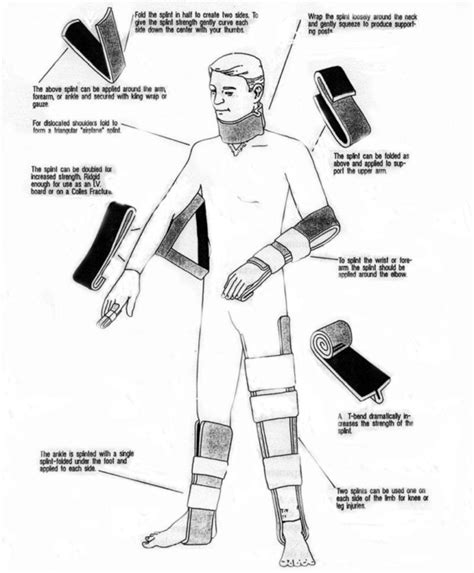 Splint Use In Ems