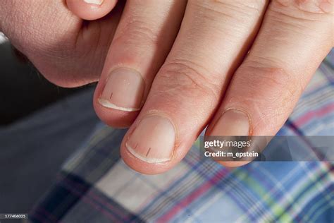 Splinter Hemorrhage Nail: Uncovering the Causes and Symptoms of This Common Nail Condition