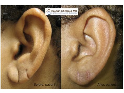 Split earlobe before and after