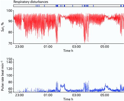 Spo2 Graph Interpretation