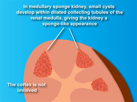 Sponge Like Kidneys