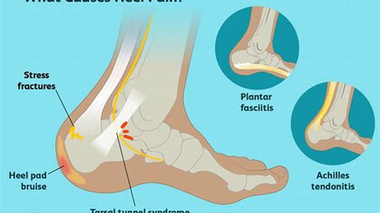 Sprained Ankle Heel Pain