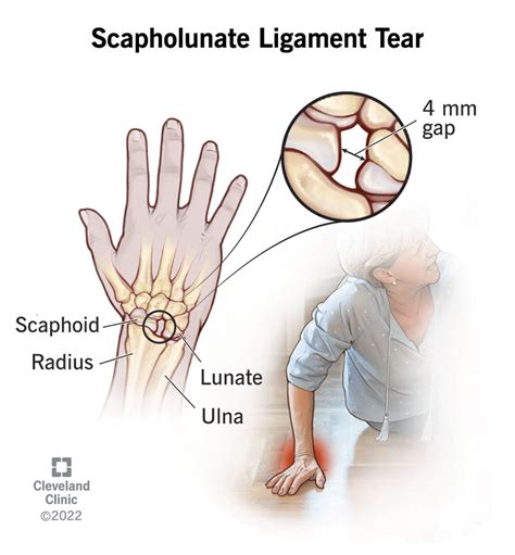 Sprained Hand Joint
