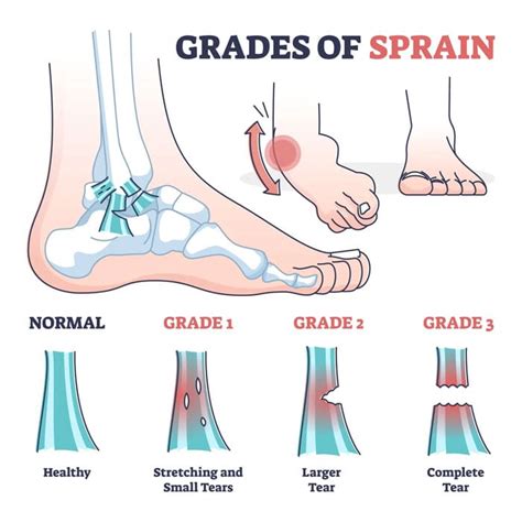 What to Do After You Sprained the Ankle: A Comprehensive Recovery Guide