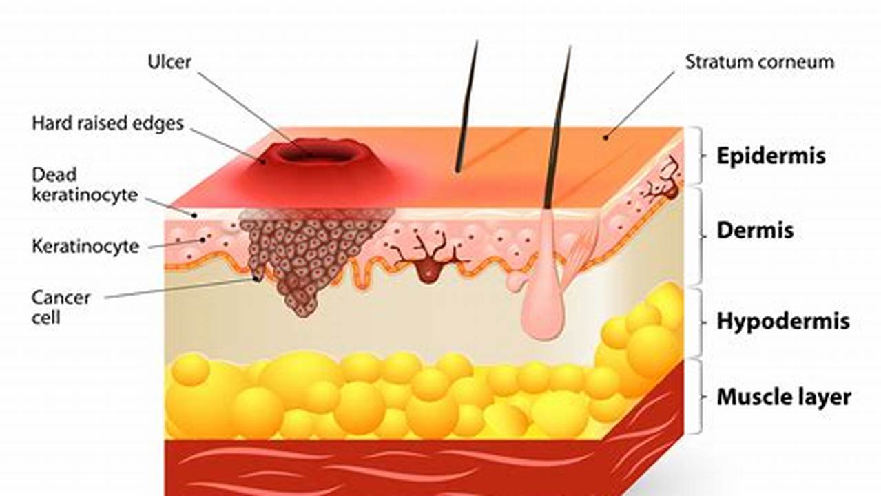 Squamous Cell Skin Cancer: A Comprehensive Guide to Causes, Symptoms, and Prevention