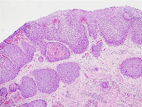 squamous cell carcinoma esophagus pathology