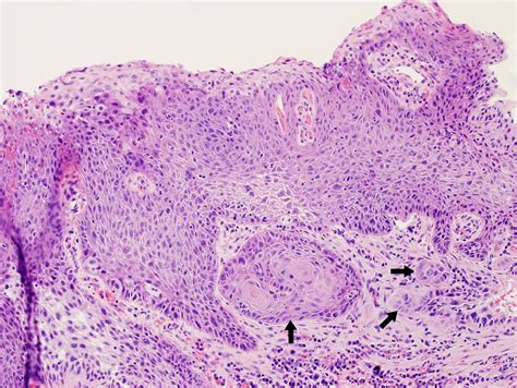 squamous cell carcinoma superficially invasive