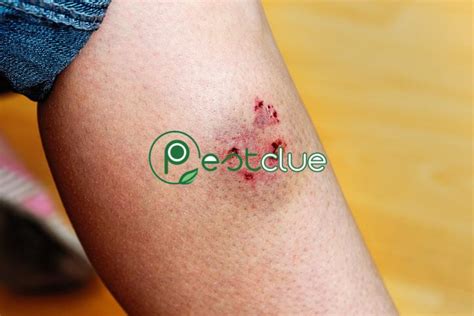 Squirrel Bite Rabies