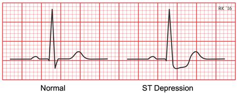 st segment depression in ecg indicates