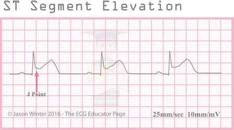 st segment elevation in ecg indicates