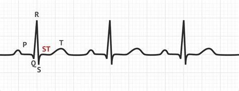 st segment in ecg indicates
