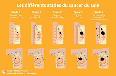 Cancer du sein de stade 3 Types, Traitement, Survie