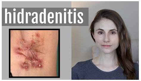 Stage 3 Hidradenitis Suppurativa Surgery Reconstruction Of Skin Defects After Resection Of Severe