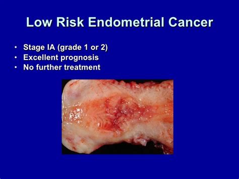 stage 1 grade 2 endometrial cancer